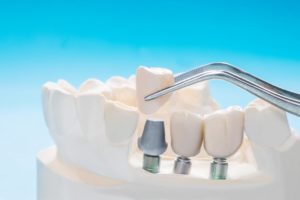 dental-bridges-geelong