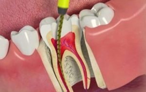 root-canal-treatment-geelong