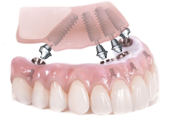 All-On-4_Immediate-dental-Implants
