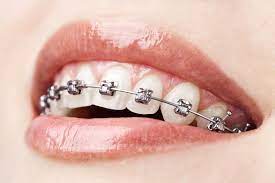 dental-braces-geelong