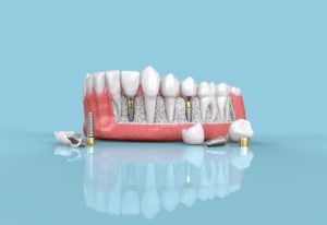 dental-implants-geelong