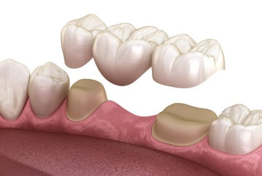 dental-bridges-geelong