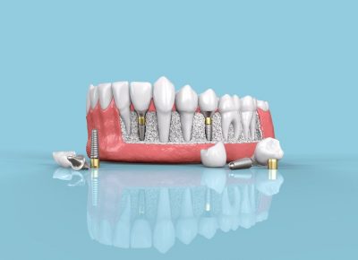dental-implants-geelong